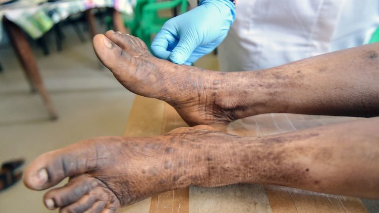 LA DÉPIGMENTATION : QUELLES CONSEQUENCES POUR LA SANTE ?